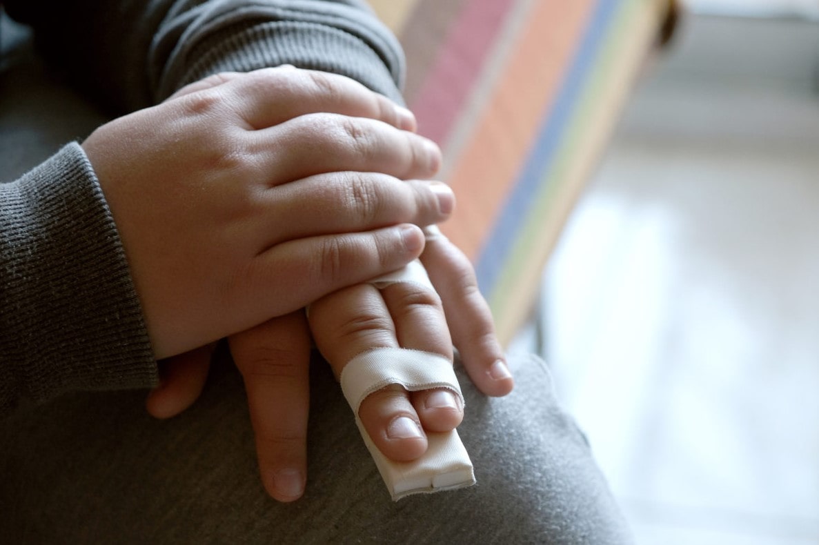 Перелом пальцев у ребенка - фото